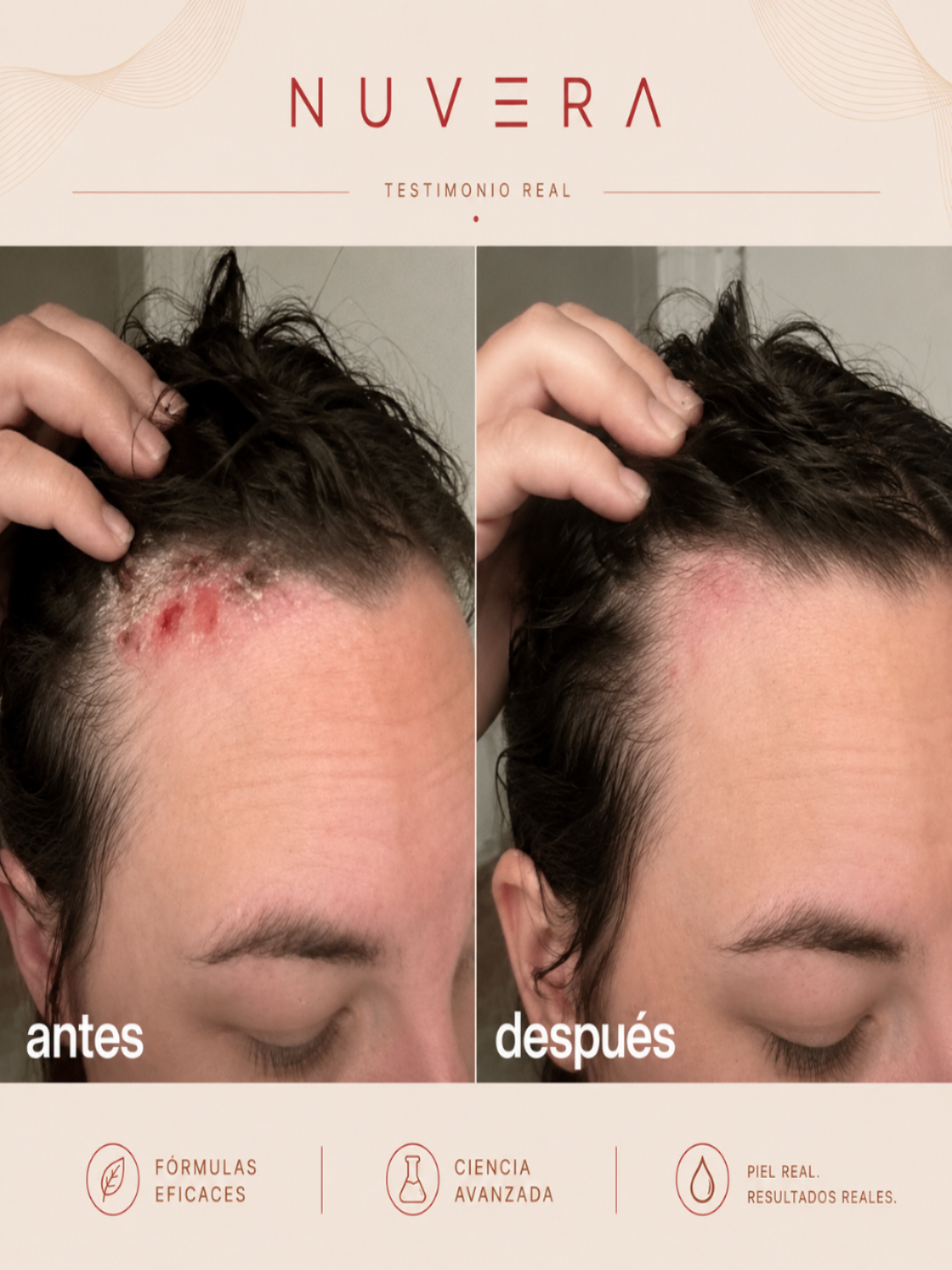 Exfoliante Anti-Caspa