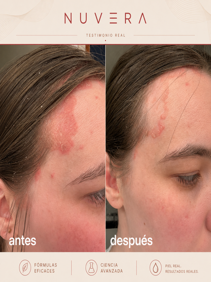 Exfoliante Anti-Caspa