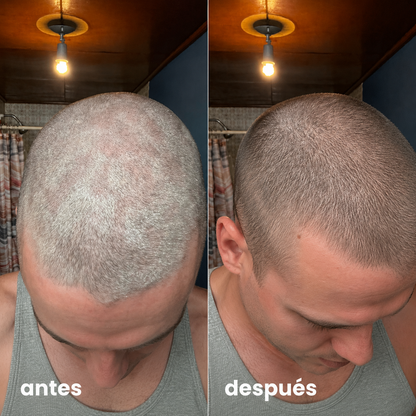Exfoliante Anti-Caspa